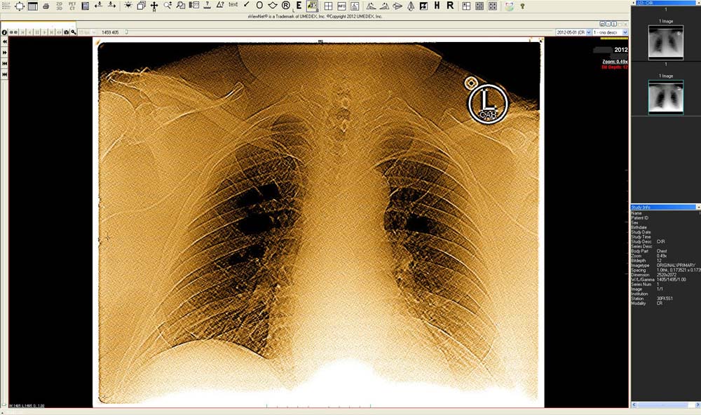 PICC line double sharp gold diagnostic x-ray