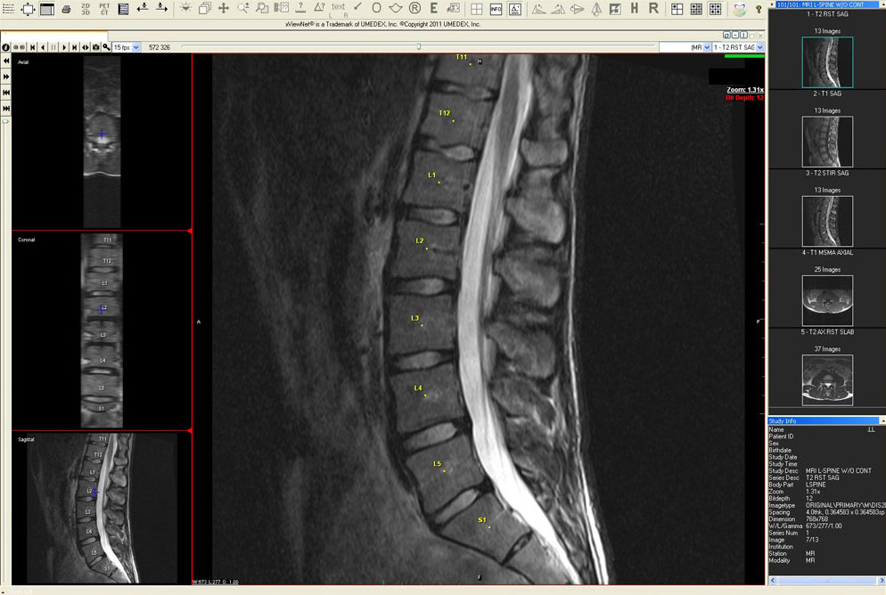 MRI spine